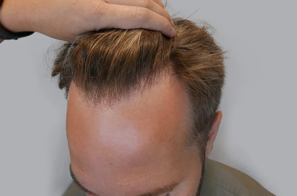 Når hårtap kommer i ung alder